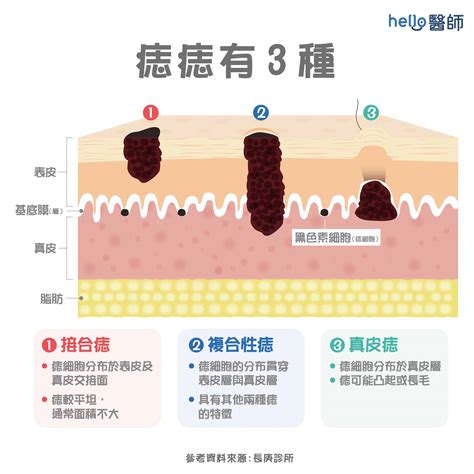 痣 長毛